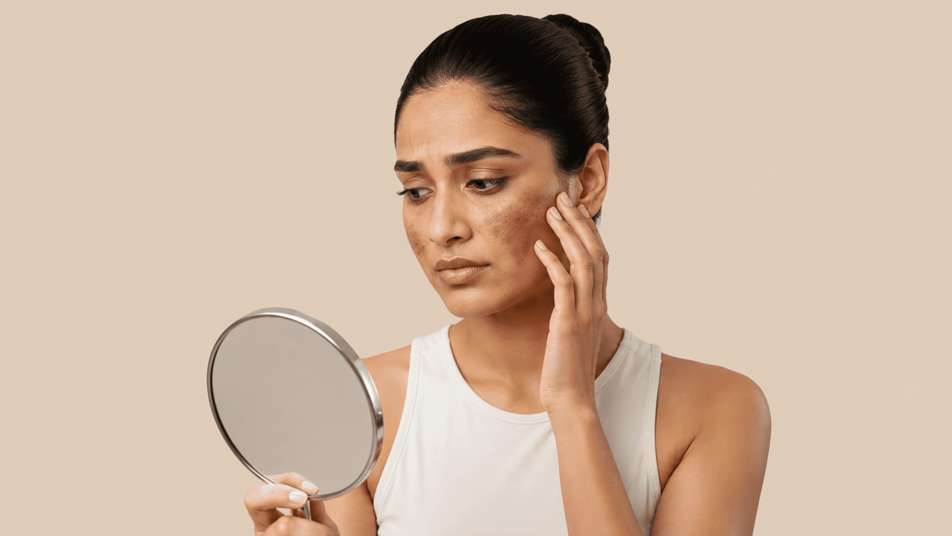 Acne And Pigmentation