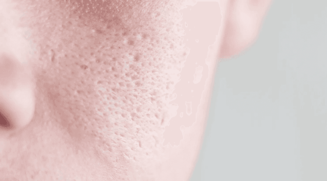 Open Pores Treatment - Dermapuritys