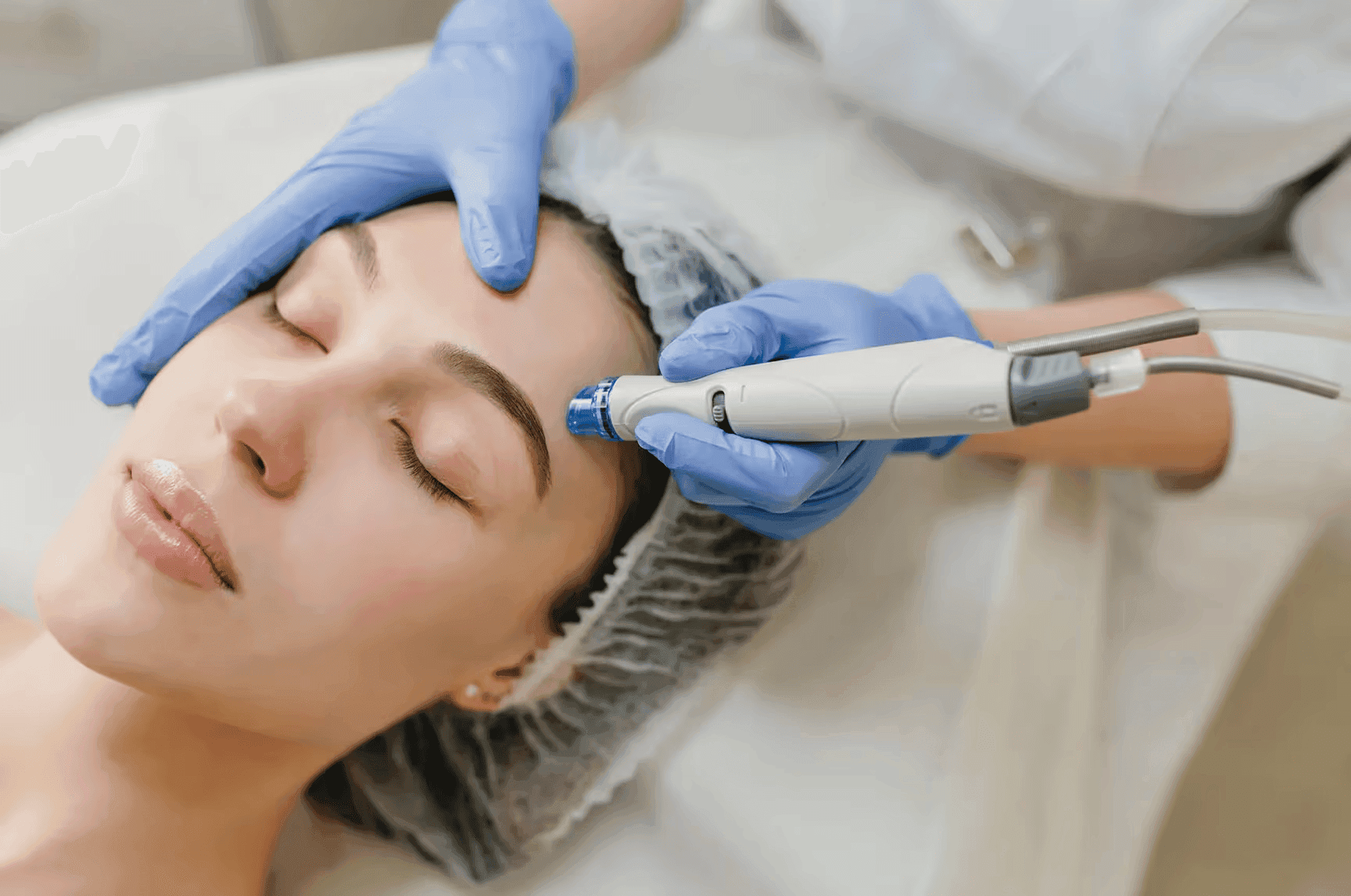 Top 5 Acne Treatments Available in Lucknow