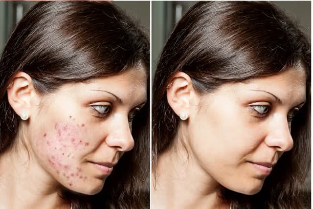 Reasons for Acne on Cheeks: How to Get Rid of Cheek Acne