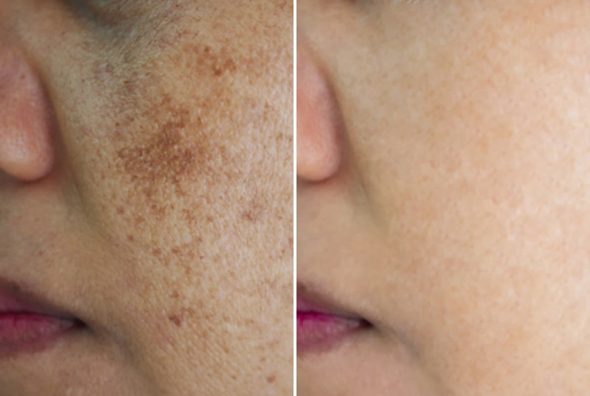 before-after-0