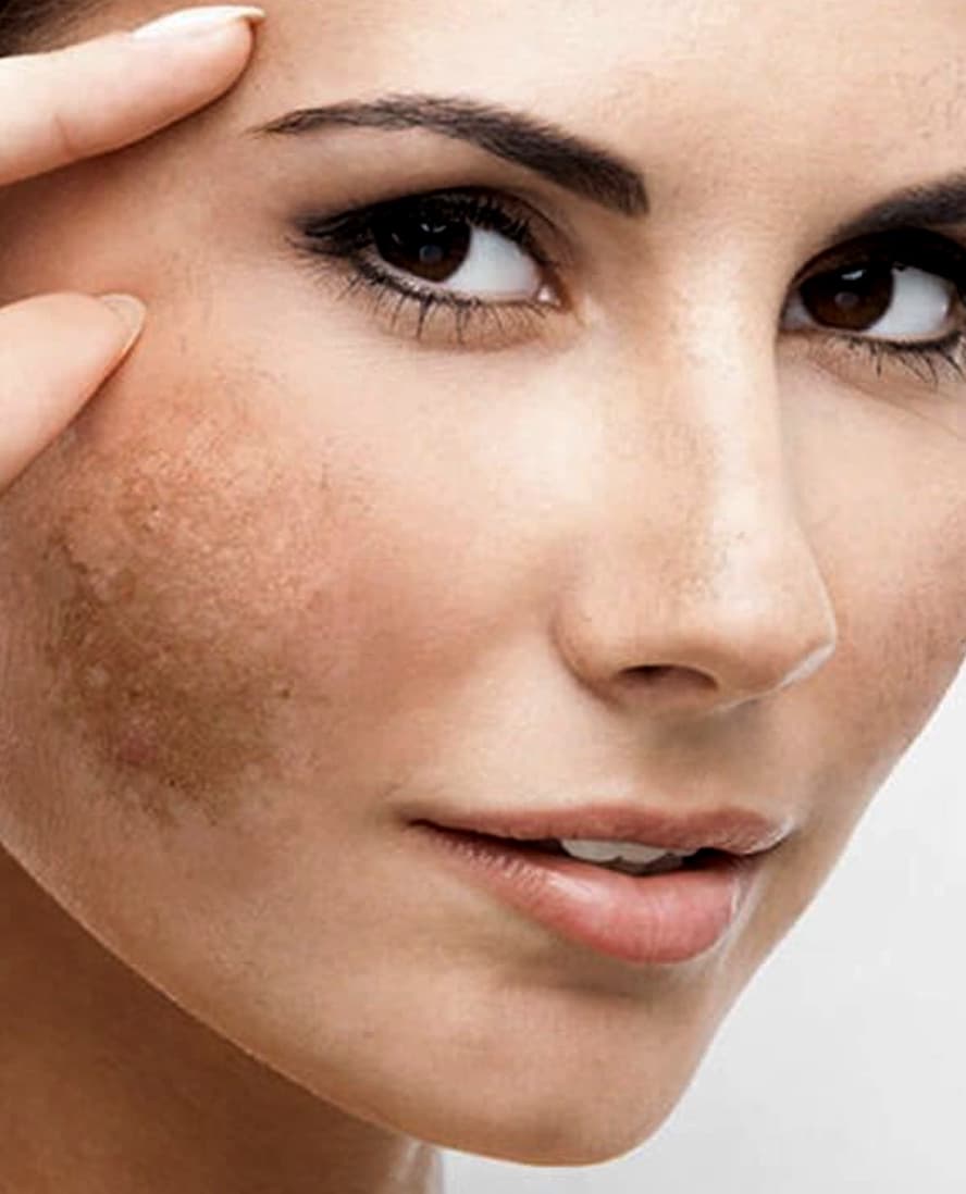 Reduces Pigmentation