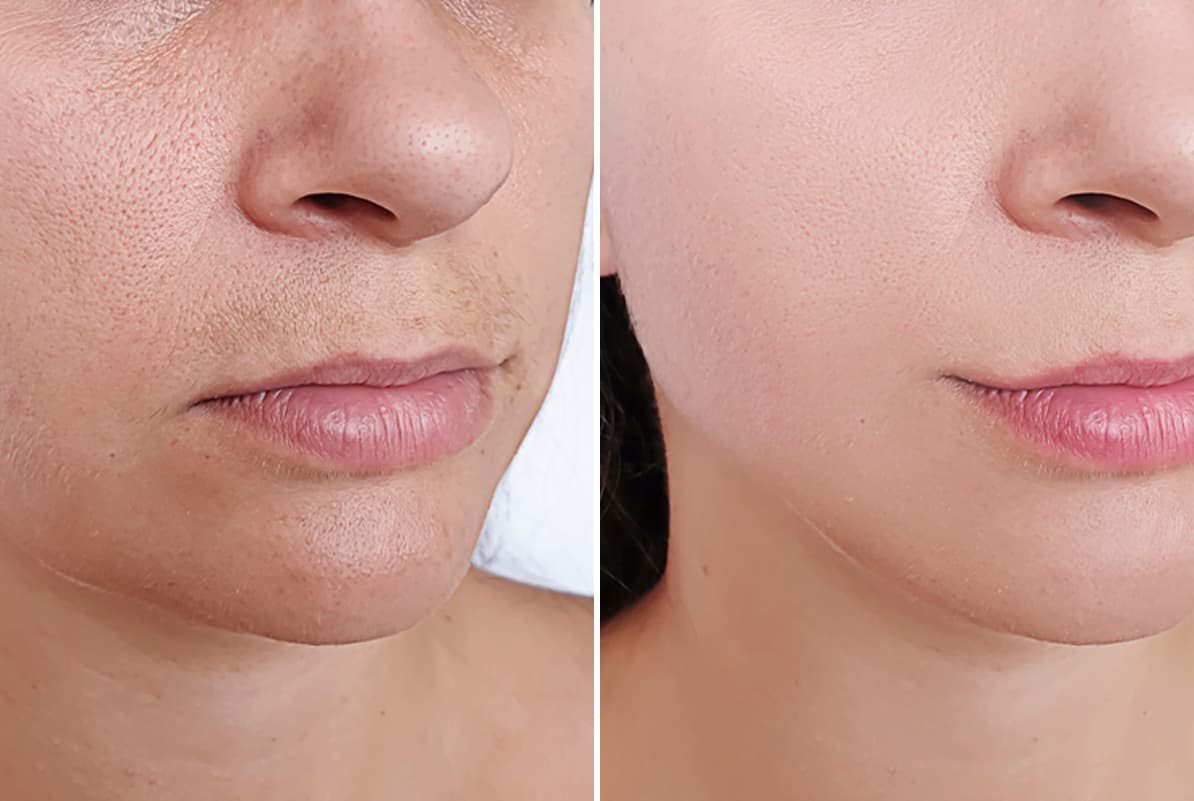 before-after-2