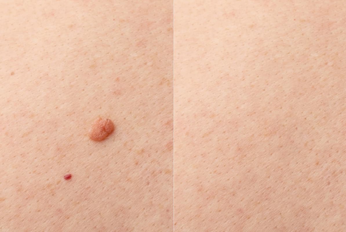 before-after-0