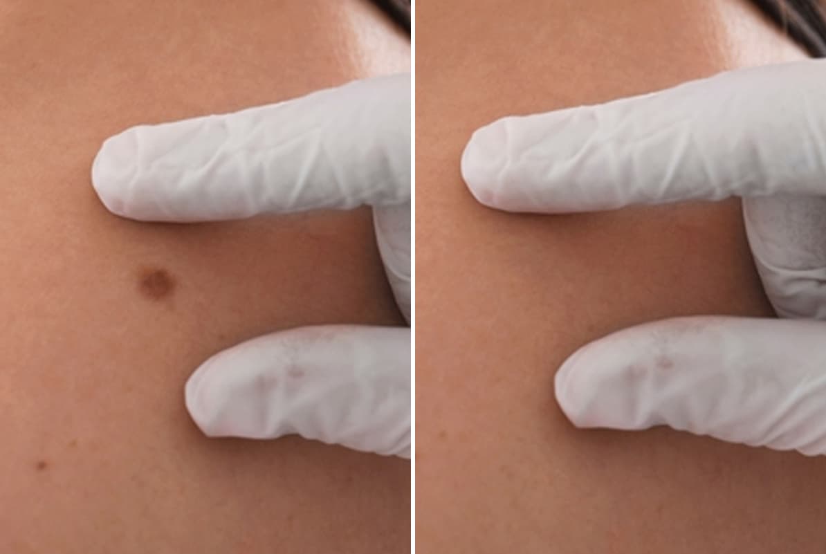 before-after-2