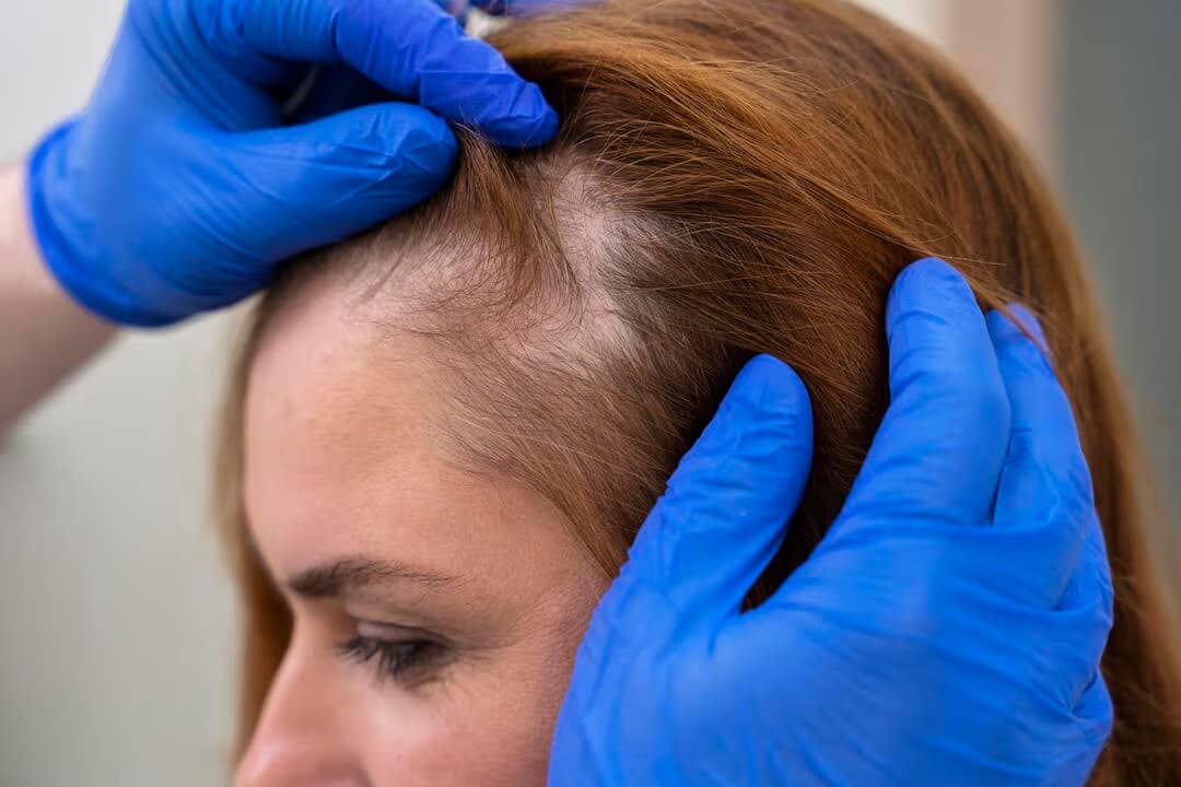 Best Hair Loss Treatment: What Actually Works for Hair Regrowth?