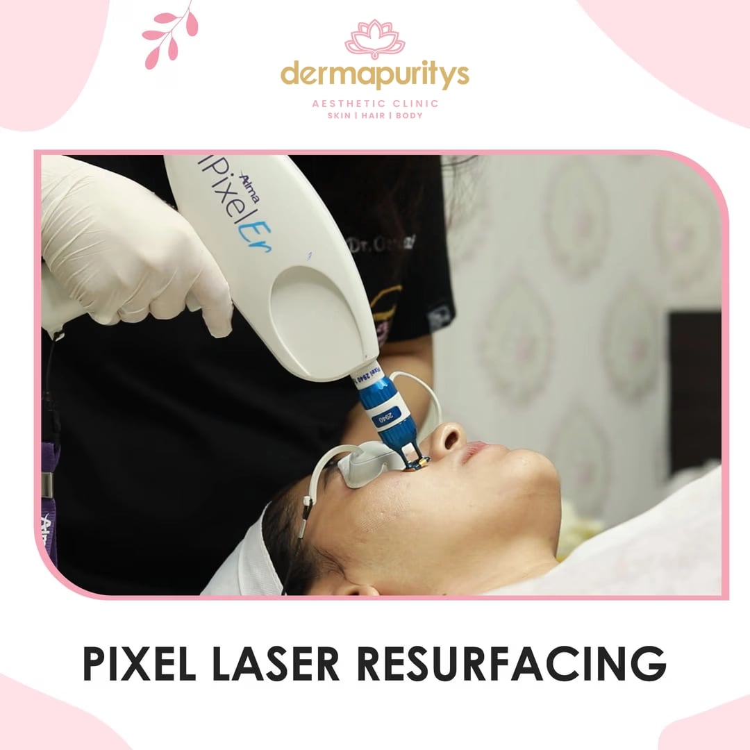 50% Off - Skin Treatment at Dermapuritys