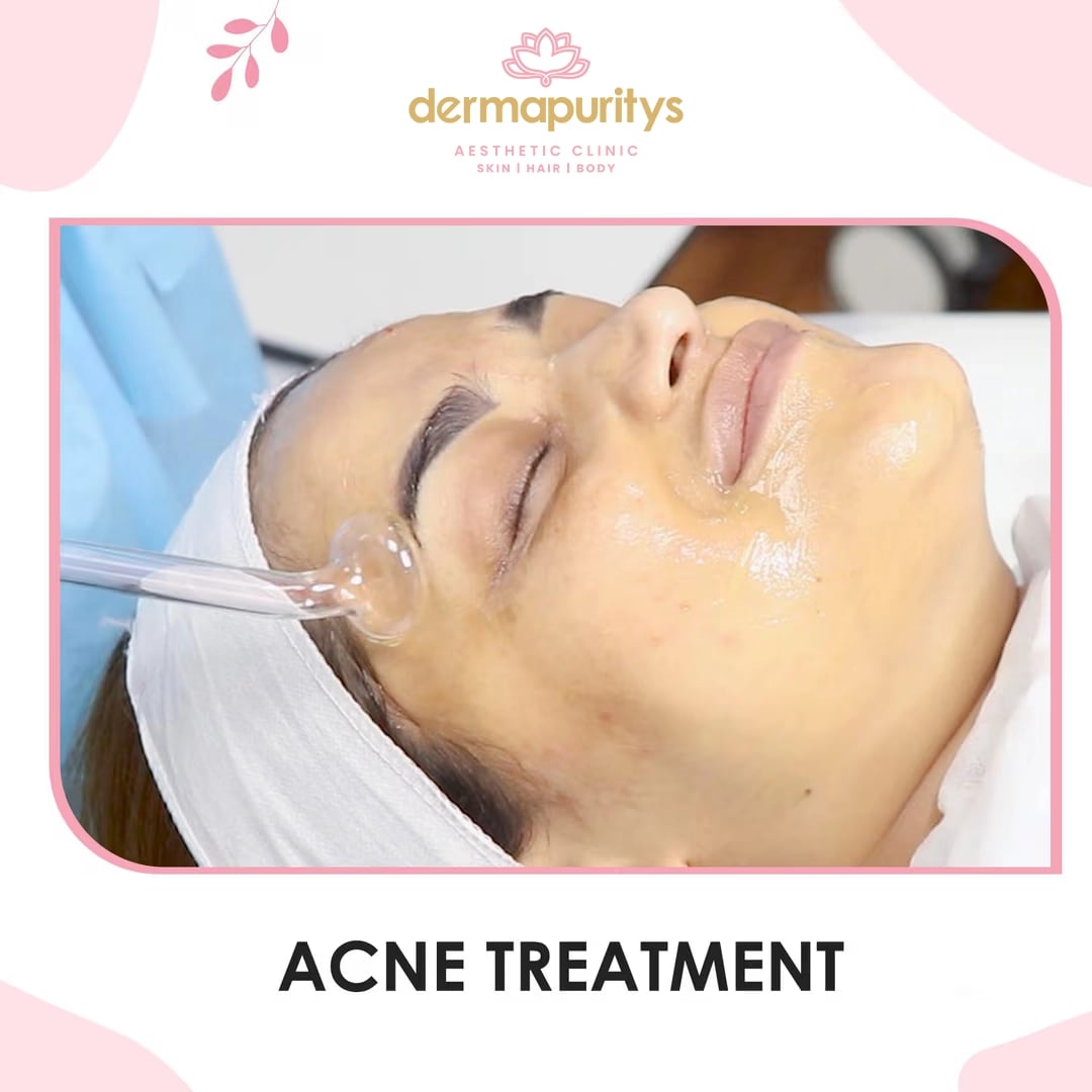 50% Off - Skin Treatment at Dermapuritys