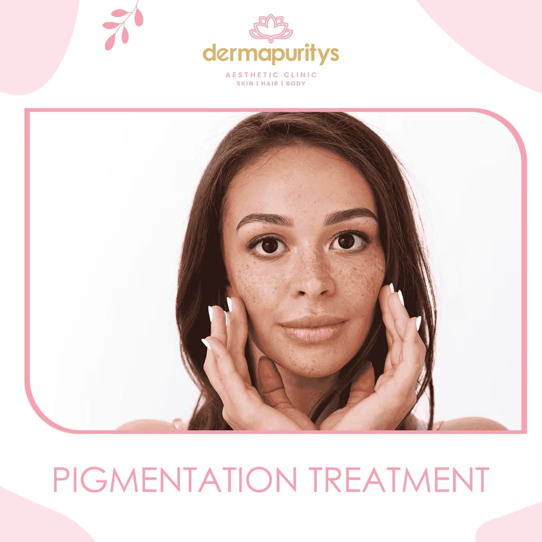 50% Off - Skin Treatment at Dermapuritys