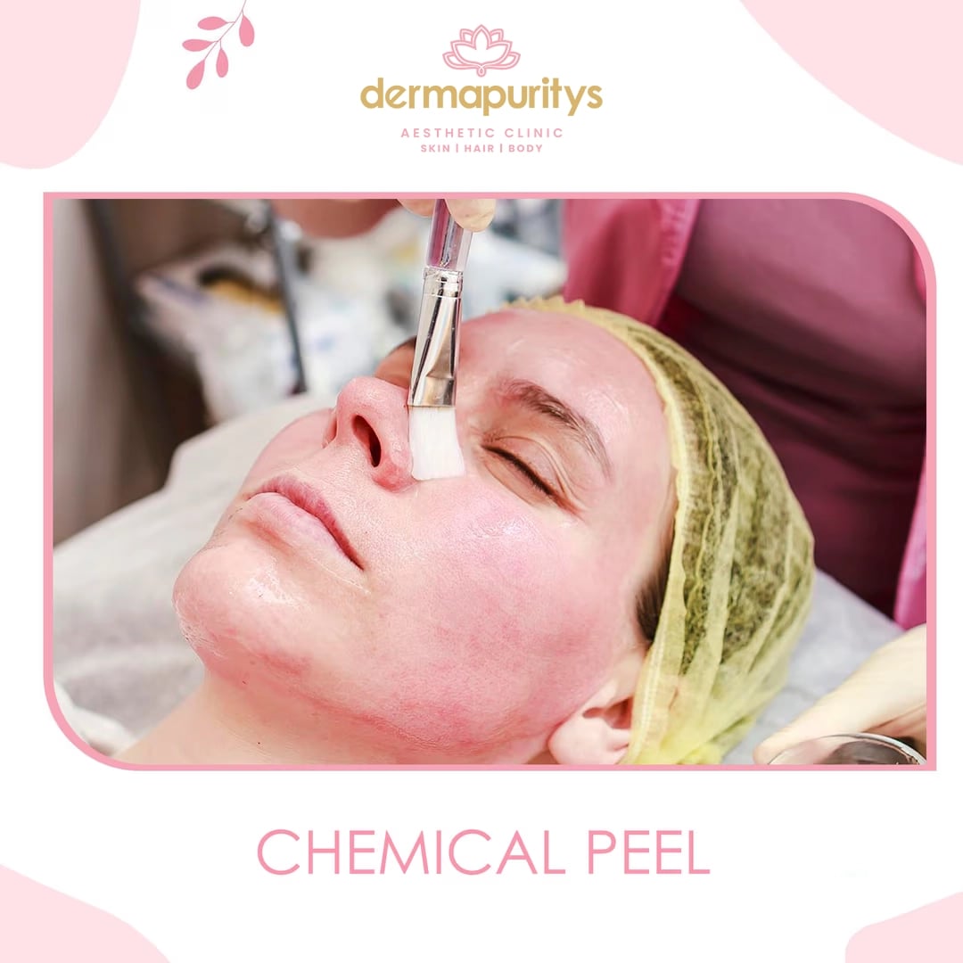 50% Off - Skin Treatment at Dermapuritys
