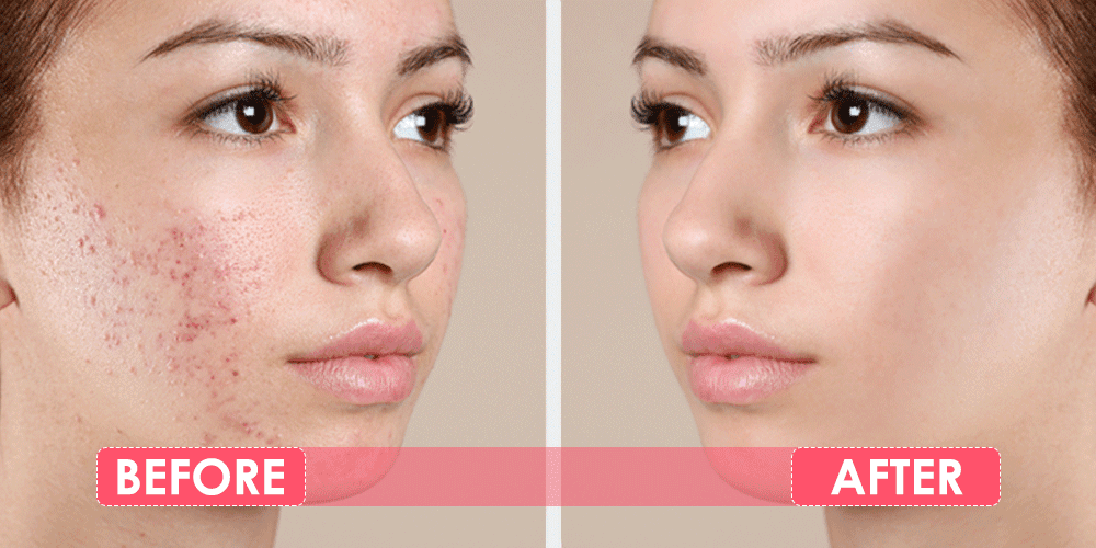 Before and After - Skin Treatment at Dermapuritys