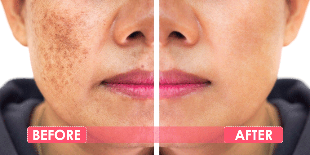 Before and After - Skin Treatment at Dermapuritys