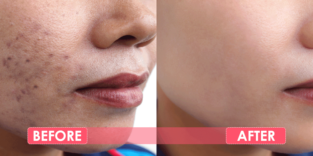 Before and After - Skin Treatment at Dermapuritys