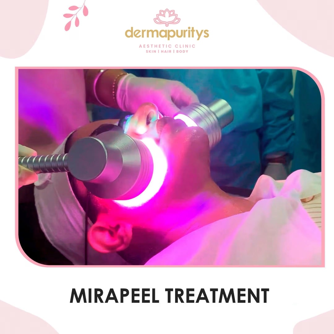 50% Off - Skin Treatment at Dermapuritys