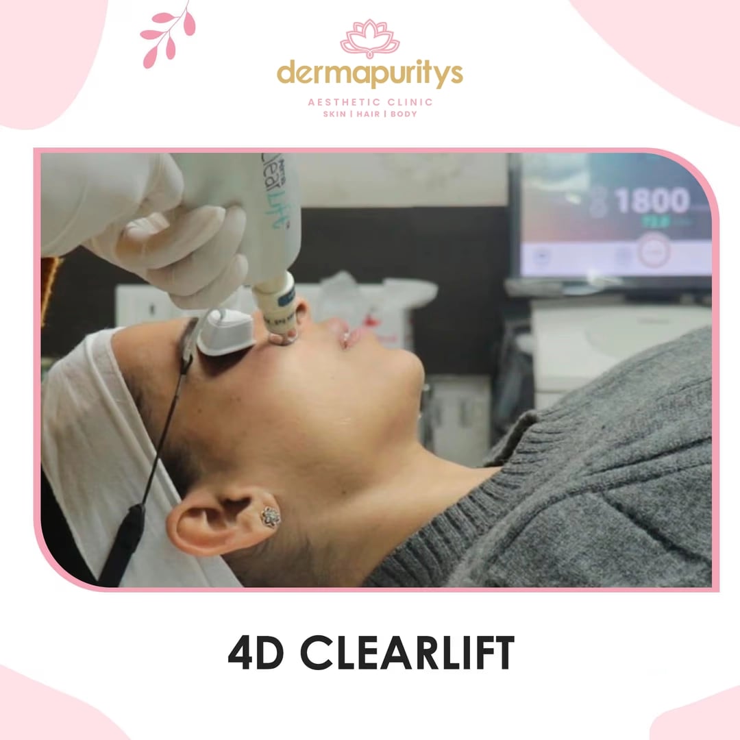 50% Off - Skin Treatment at Dermapuritys