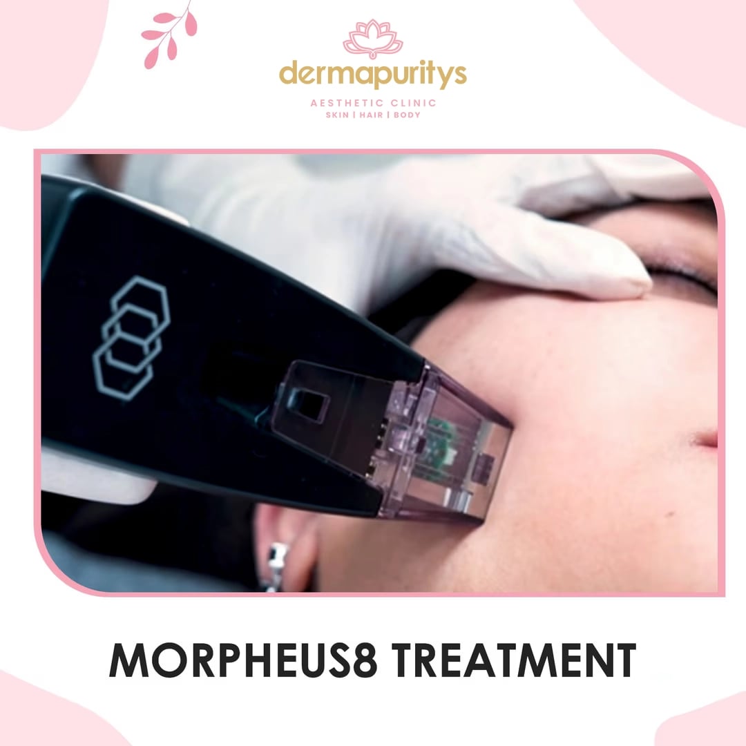 50% Off - Skin Treatment at Dermapuritys