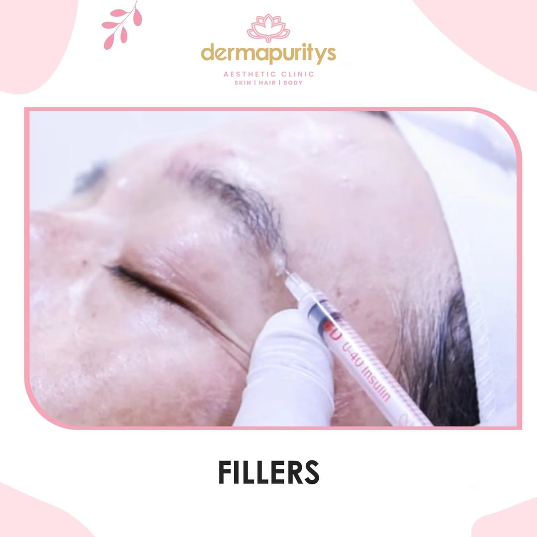 50% Off - Skin Treatment at Dermapuritys