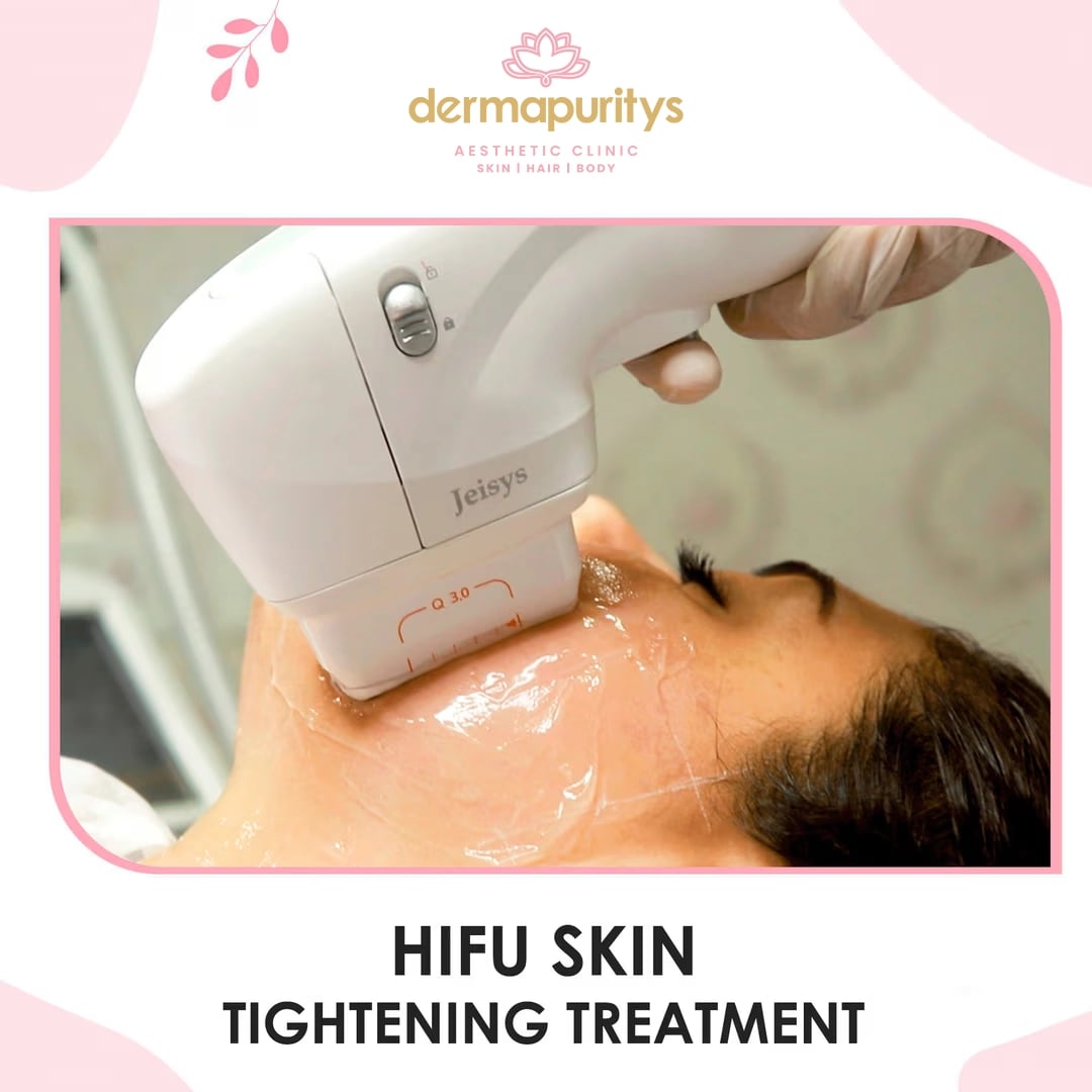 50% Off - Skin Treatment at Dermapuritys