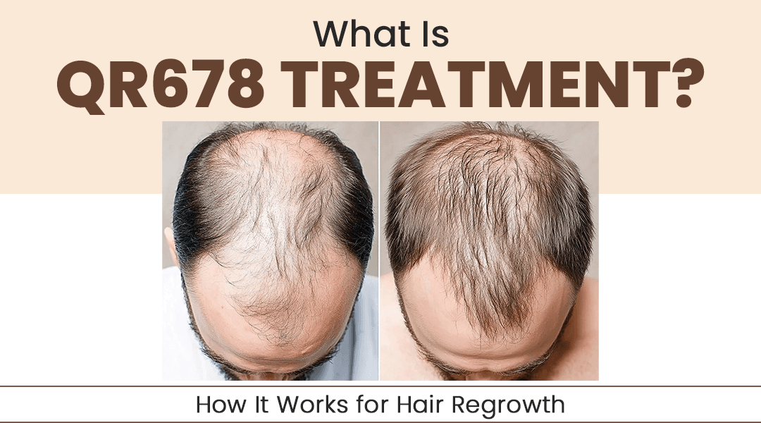 What Is QR678 Treatment? How It Works for Hair Regrowth