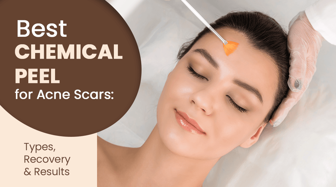 Best Chemical Peel for Acne Scars: Types, Recovery & Results