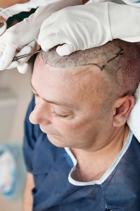 Advanced Hair Transplant || Derma Puritys